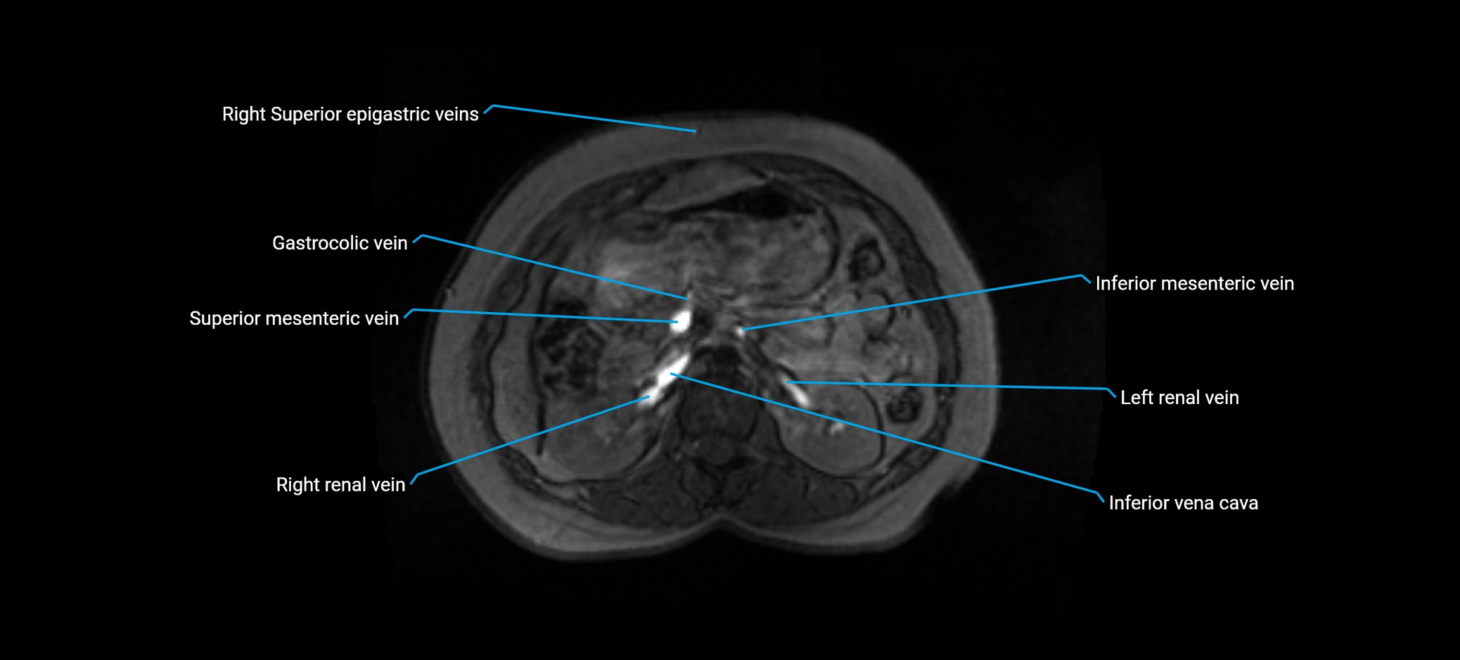 MRV abdomen pelvis & lower limb axial cross sectional anatomy labelled MRI image 64 (1).webp